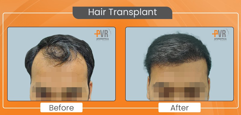 Hair Transplant_1