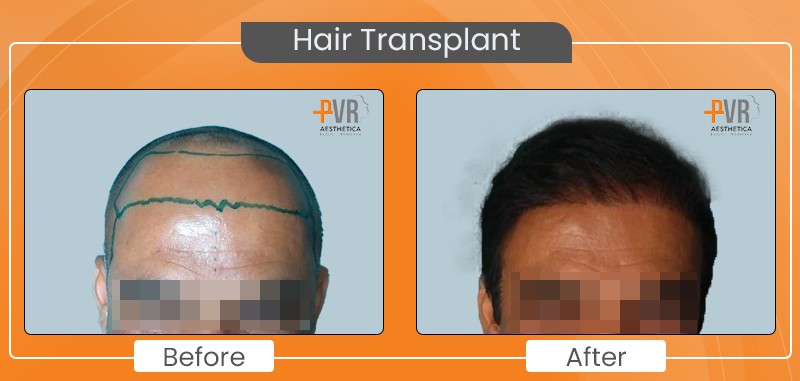 Hair Transplant_2