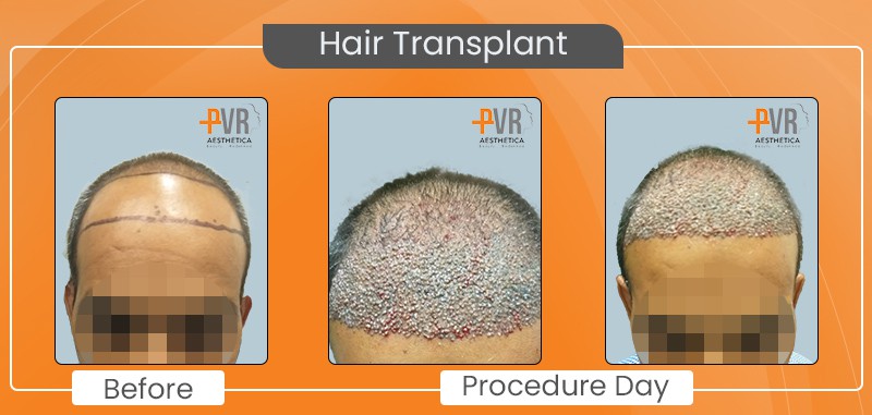 Hair Transplant_3