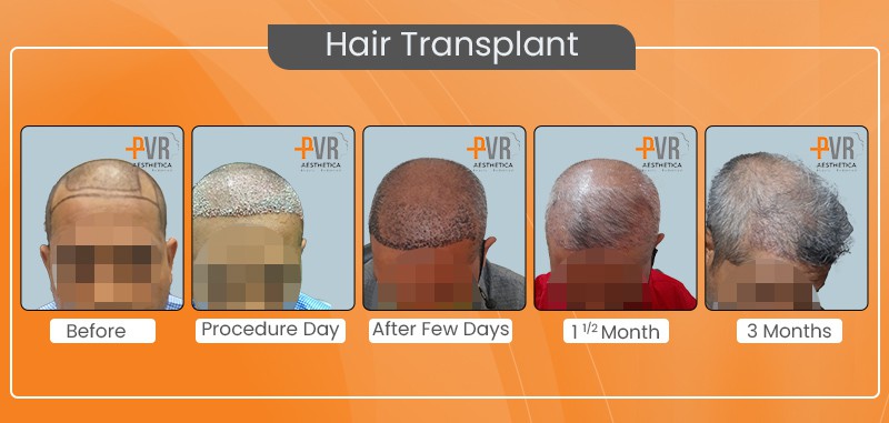 Hair Transplant_4