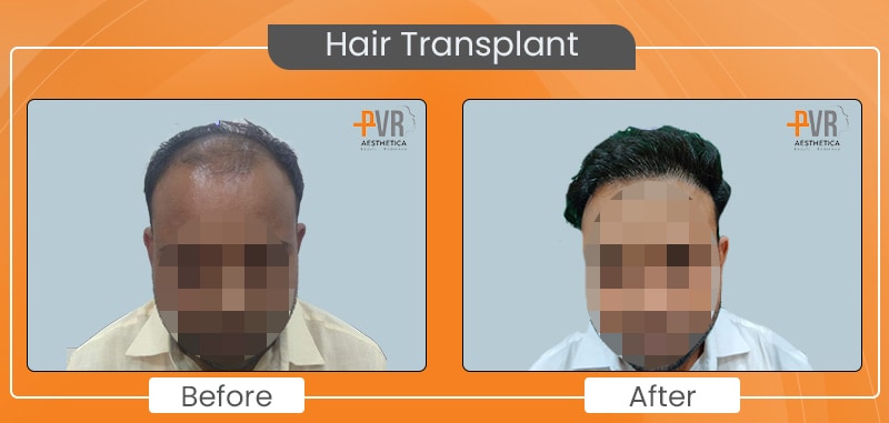 Hair Transplant_5