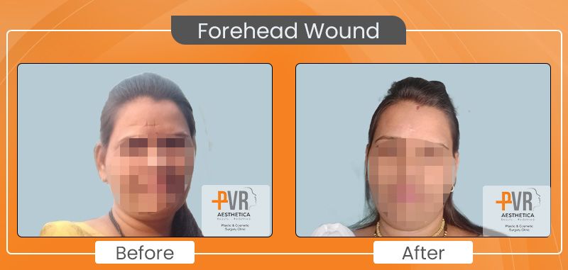 Forehead Wound faceblur