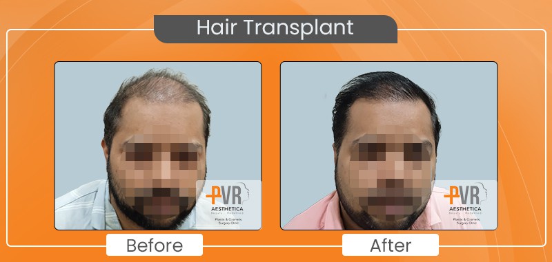 Hair Transparent 2 faceblur
