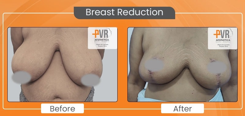 Breast-reduction