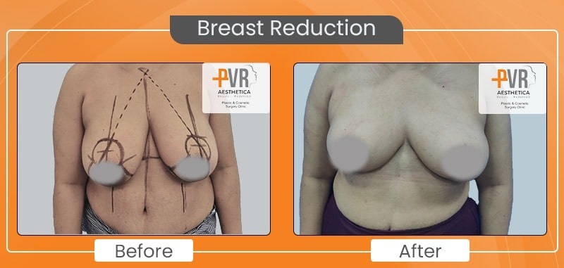 Breast-reduction2