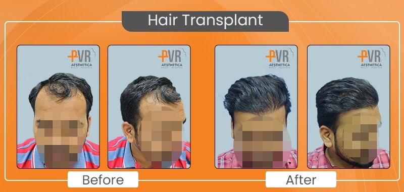 Hair Transplant_3-min