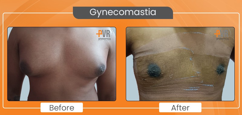Gynecomastia_3