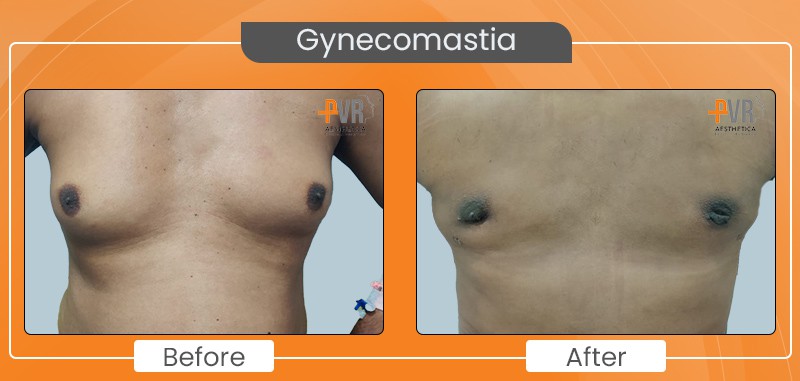 Gynecomastia_4