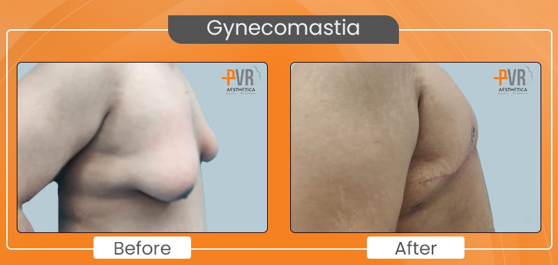 Gynecomastia_5