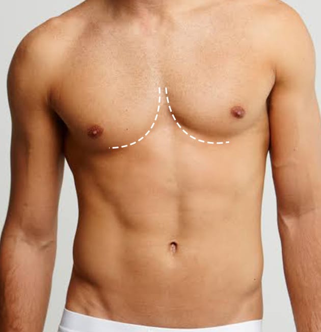 Gynecomastia types classified by Dr. Cruise