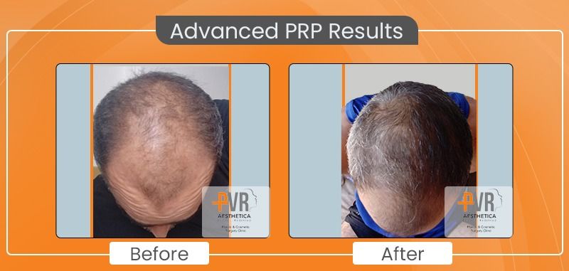 Best Prp Hair Treatment In Navi Mumbai| Pvr Aesthetica
