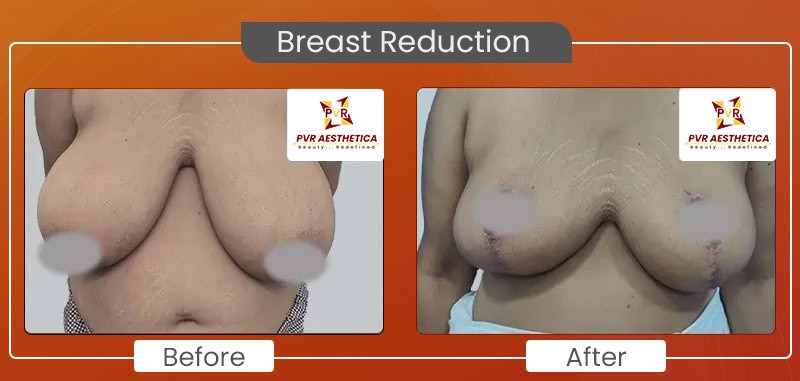 Breast reduction 1