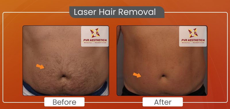 Laser hair removal 3