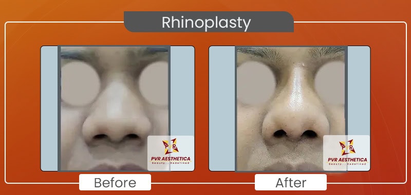 Rhinoplasty