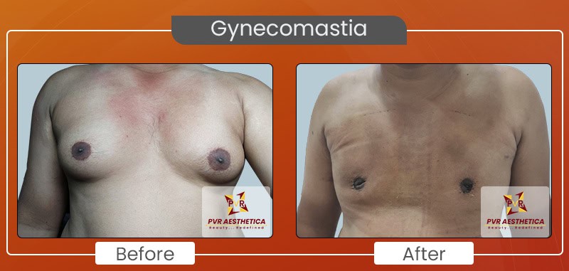 gynecomastia 6
