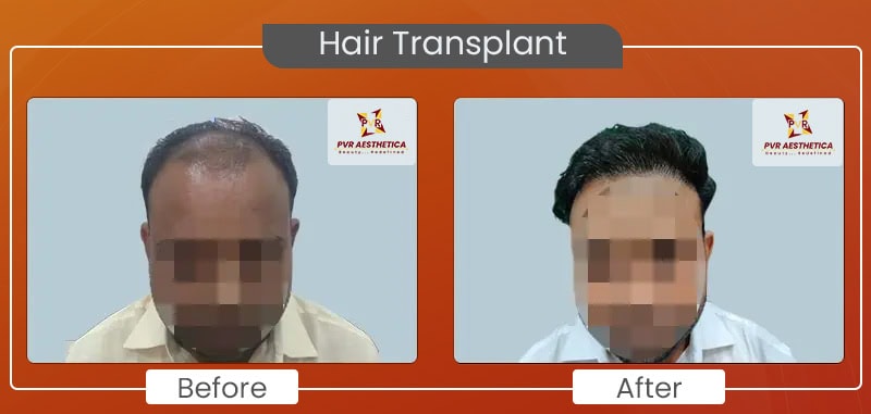 hair transplant 9
