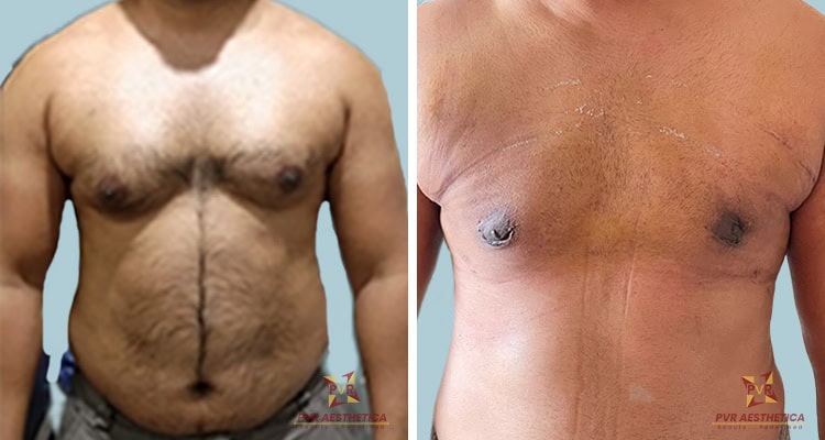 Gynecomastia 5
