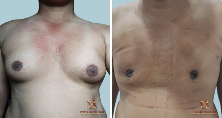 Gynecomastia 7 (1)