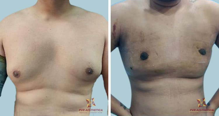 Gynecomastia 8 (1)