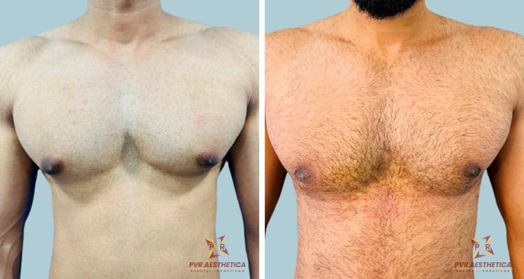 Gynecomastia 9 (1)