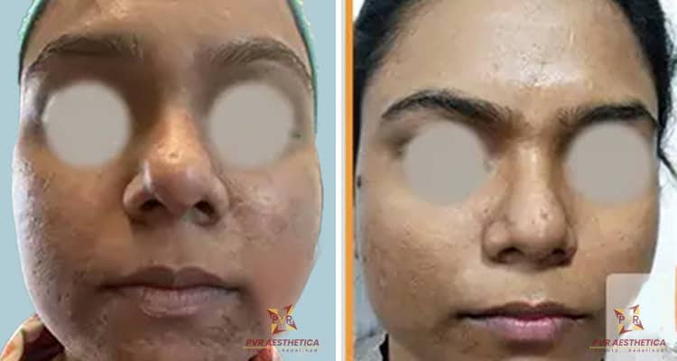 Chemical peel 2