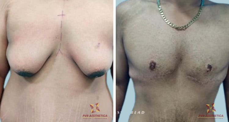 Gynecomastia 10