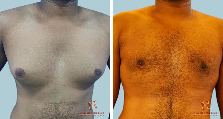 Gynecomastia 11