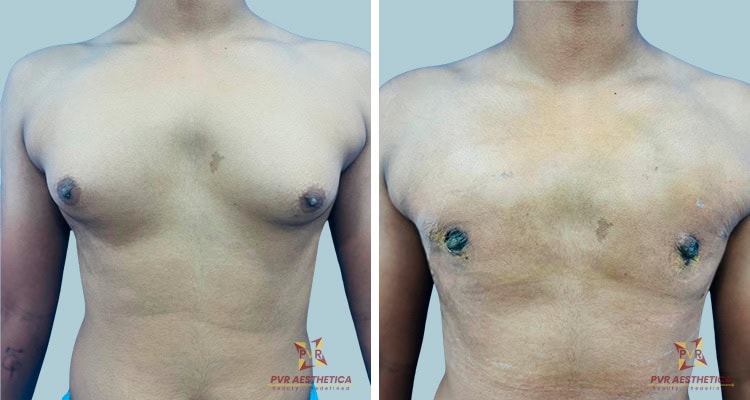Gynecomastia 13